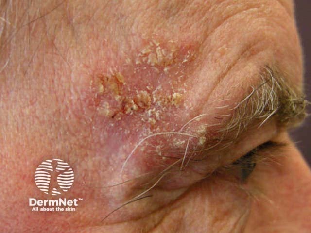 Squamous cell carcinoma on the face