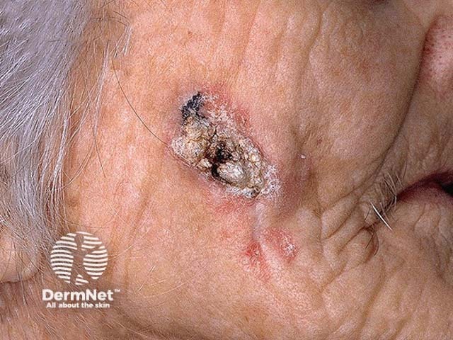 Squamous cell carcinoma on the face