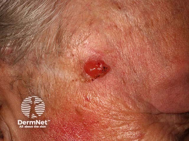 Squamous cell carcinoma on the face