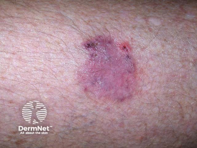 Intraepidermal carcinoma