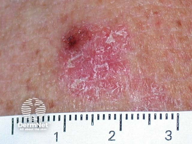 Intraepidermal carcinoma