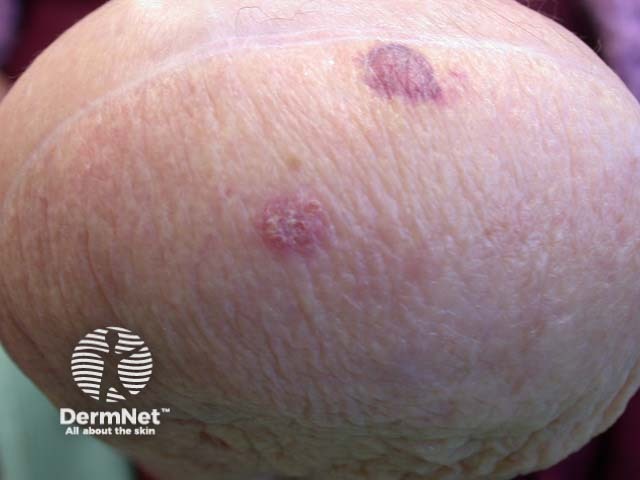 Intraepidermal carcinoma