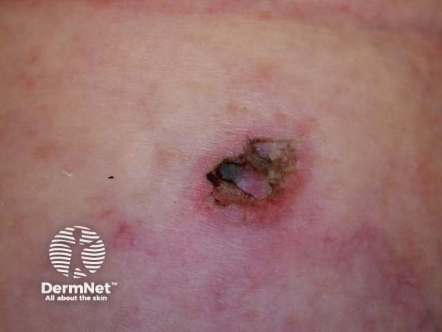 Intraepidermal carcinoma