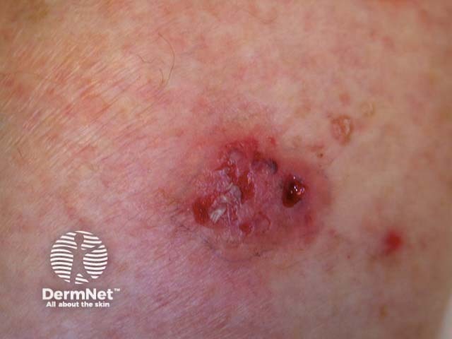 Intraepidermal carcinoma