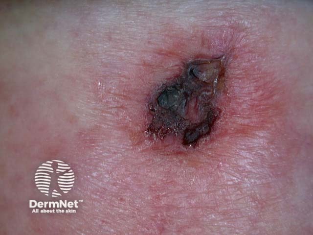 Intraepidermal carcinoma