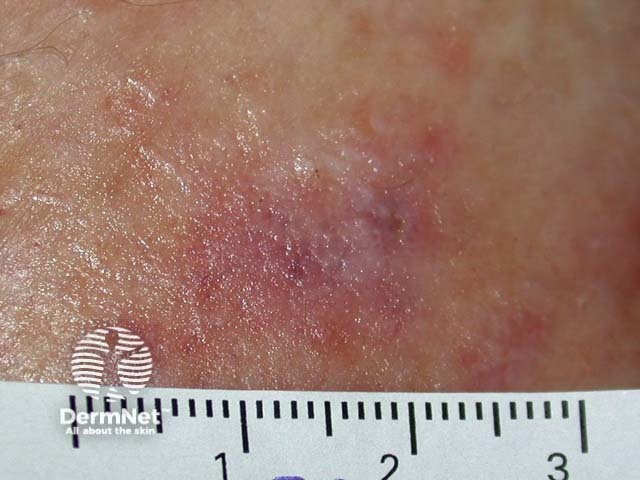 Intraepidermal carcinoma