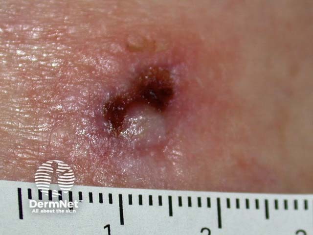 Intraepidermal carcinoma