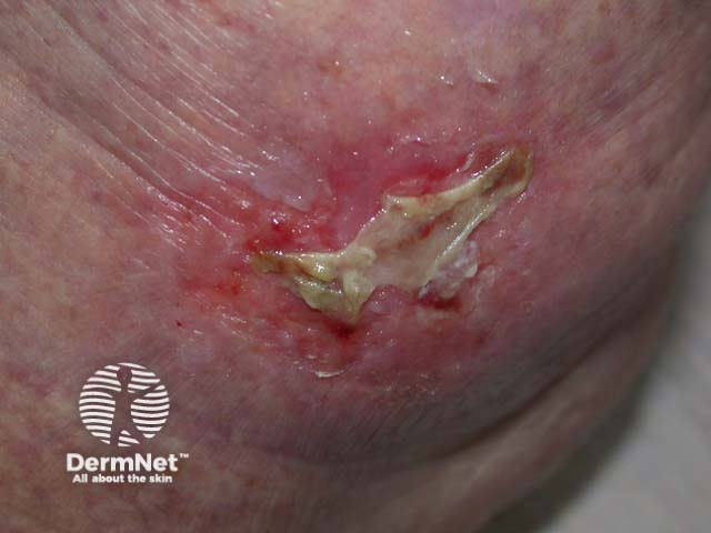 Intraepidermal carcinoma