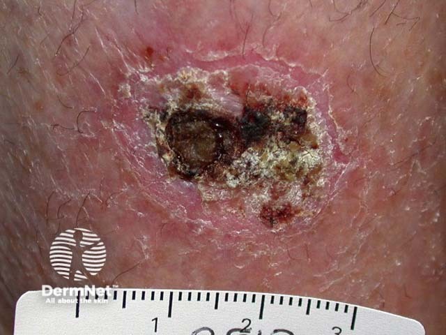 Intraepidermal carcinoma