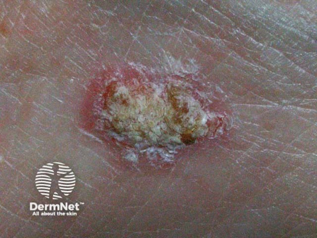 Intraepidermal carcinoma