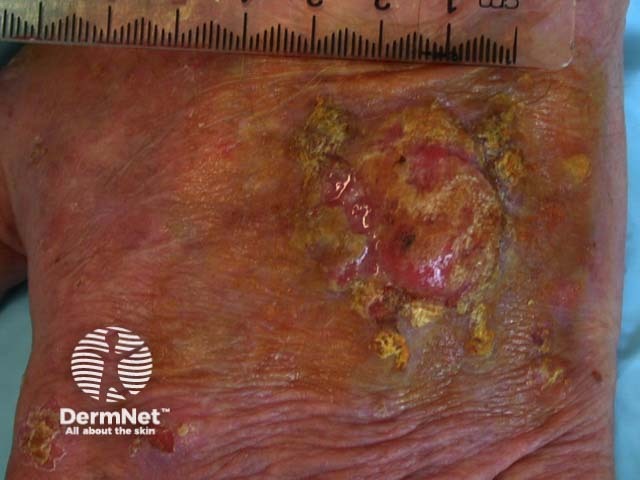 Intraepidermal carcinoma