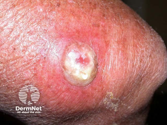 Intraepidermal carcinoma