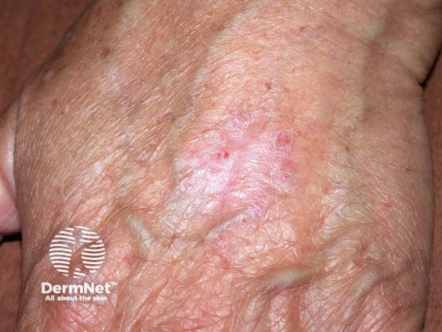 Intraepidermal carcinoma