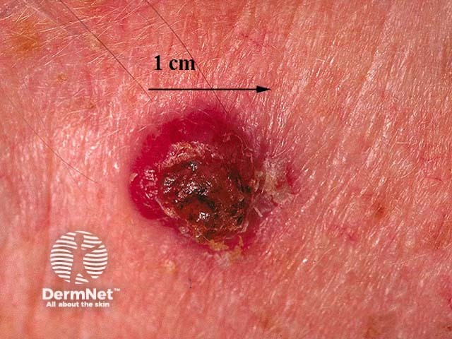 Squamous cell carcinoma of limbs