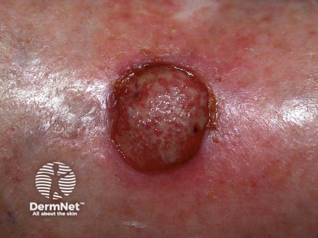 Squamous cell carcinoma of limbs