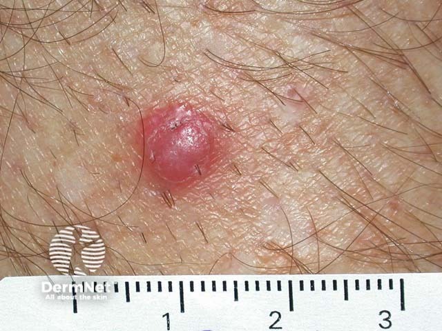 Squamous cell carcinoma of limbs