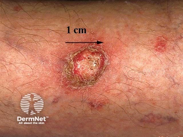 Squamous cell carcinoma of limbs