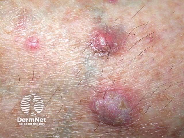 Squamous cell carcinoma of limbs