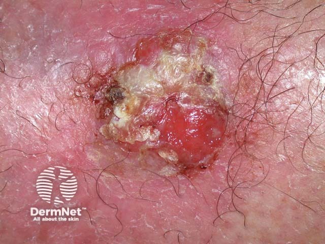 Squamous cell carcinoma of limbs