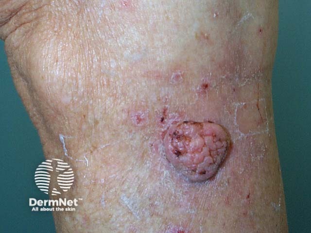 Squamous cell carcinoma of limbs