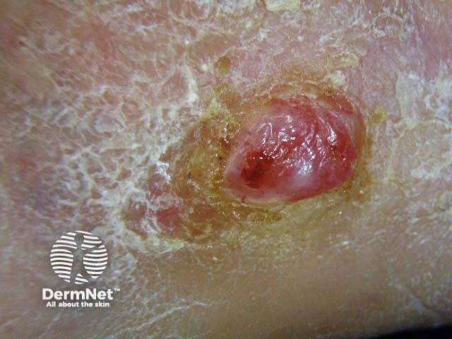 Squamous cell carcinoma of limbs