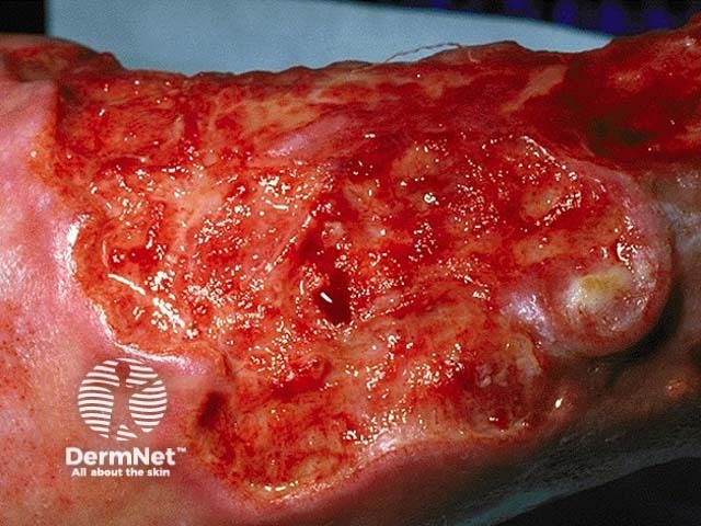 Squamous cell carcinoma of limbs