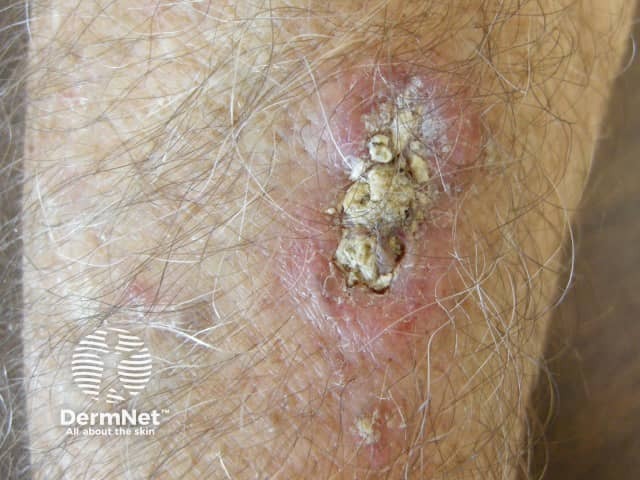 Squamous cell carcinoma