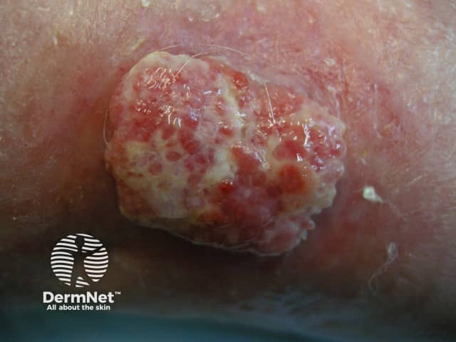 Squamous cell carcinoma