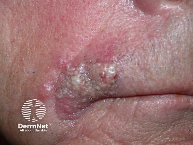 Sebaceous carcinoma