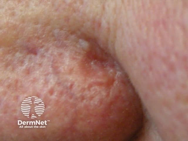 Sebaceous carcinoma