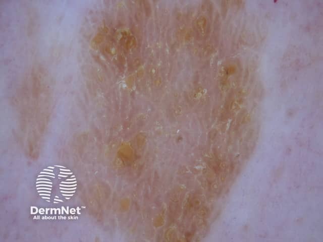 Seborrhoeic keratosis dermoscopy