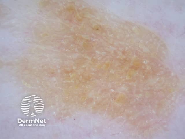 Seborrhoeic keratosis dermoscopy