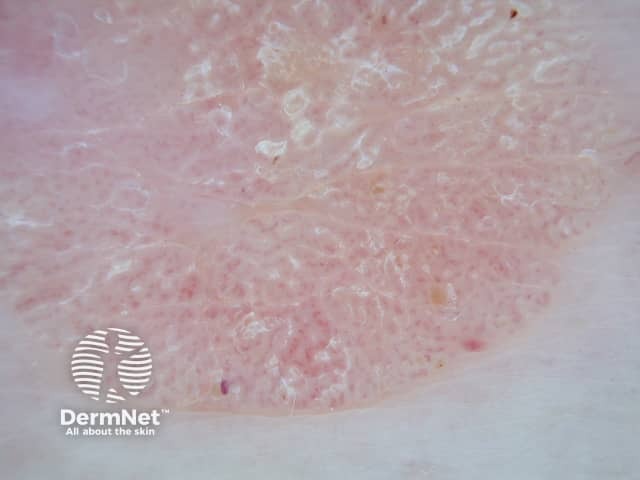 Seborrhoeic keratosis dermoscopy