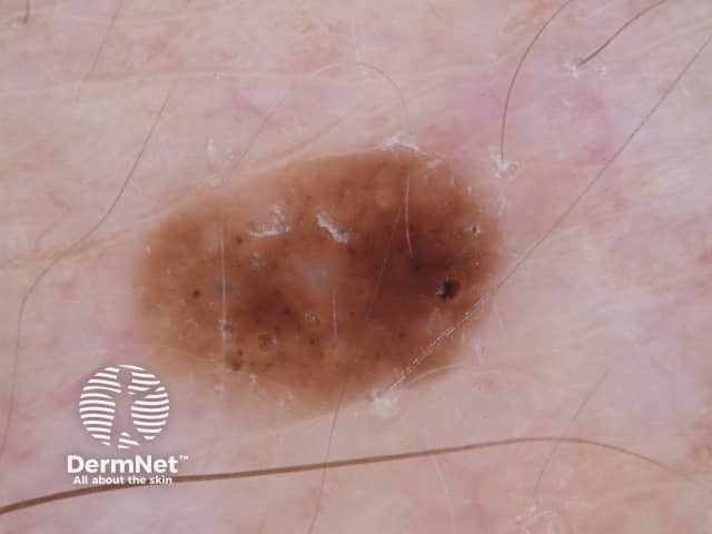 Seborrhoeic keratosis dermoscopy