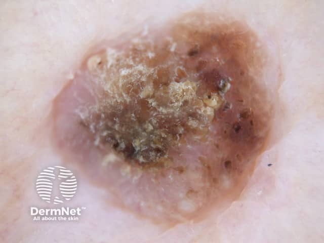 Seborrhoeic keratosis dermoscopy