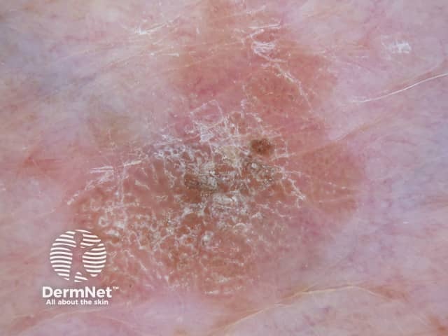 Seborrhoeic keratosis dermoscopy