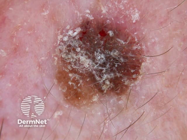 Seborrhoeic keratosis dermoscopy