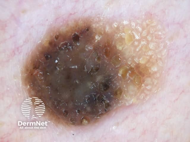 Seborrhoeic keratosis dermoscopy