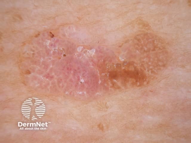 Seborrhoeic keratosis dermoscopy