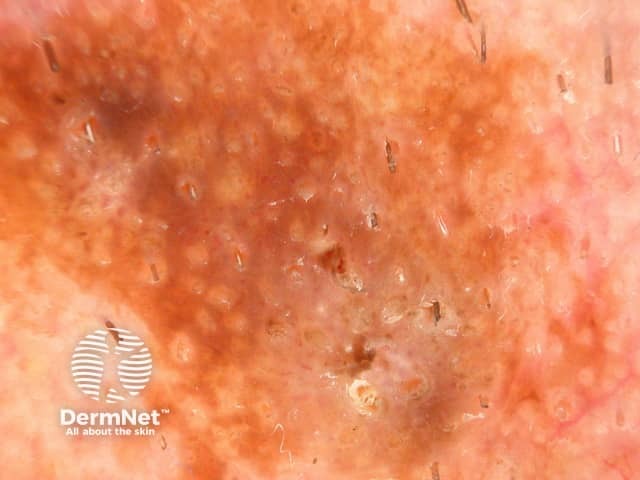 Dermoscopy of seborrhoeic keratosis 