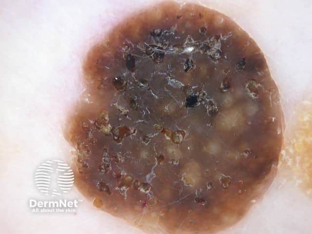 Seborrhoeic keratosis dermoscopy