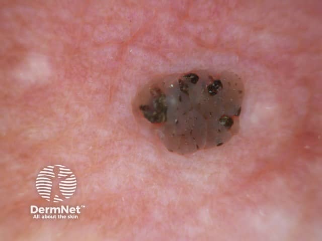 Seborrhoeic keratosis dermoscopy