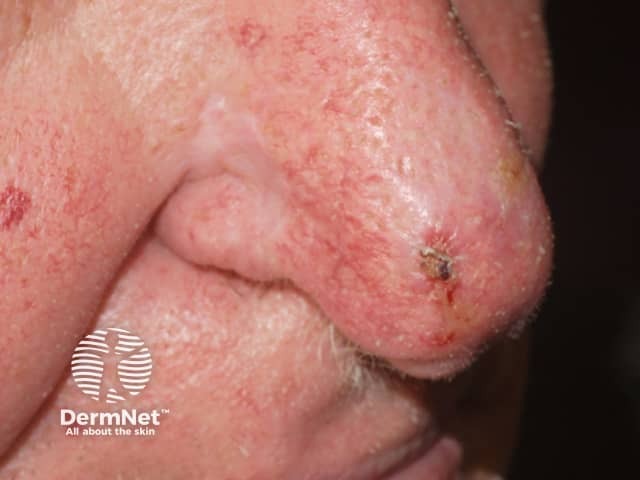 Actinic keratoses on the nose