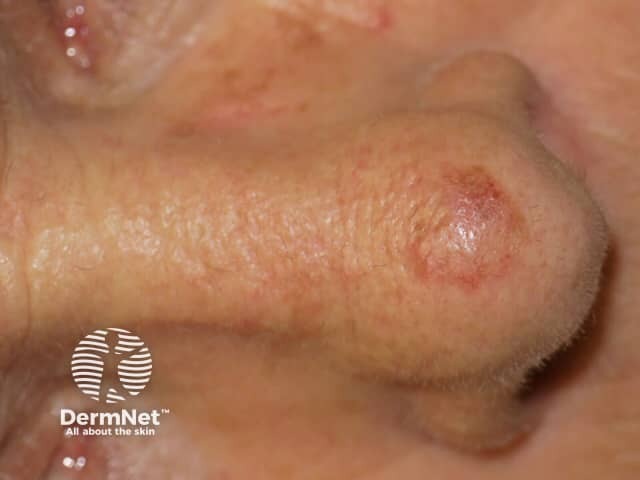 Actinic keratoses on the nose