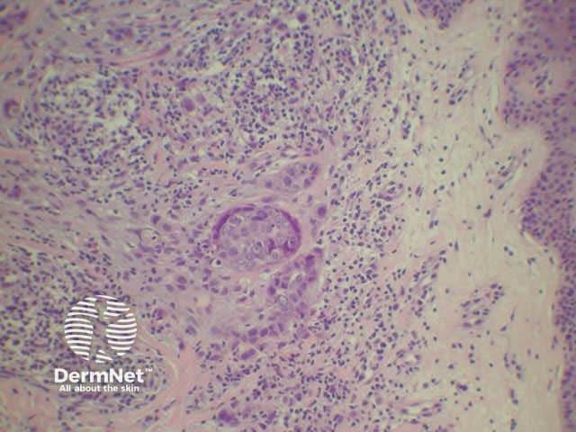 Sister Mary Joseph's nodule of the umbilicus