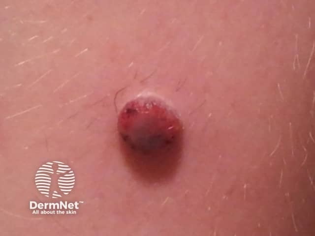 Spitzoid melanoma in 10-year-old