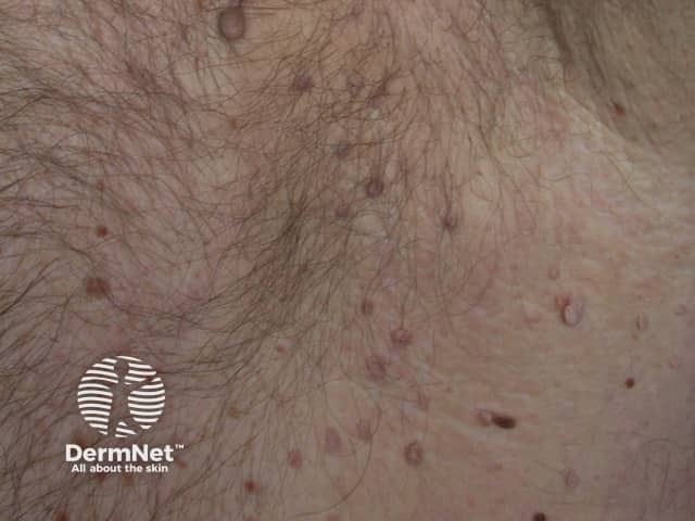 Seborrhoeic keratosis