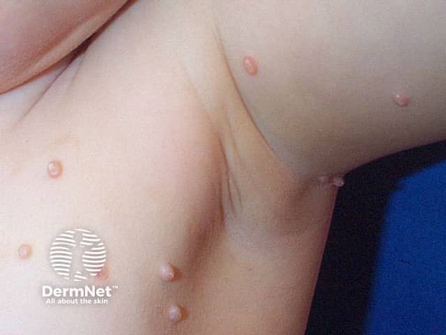 Molluscum contagiosum