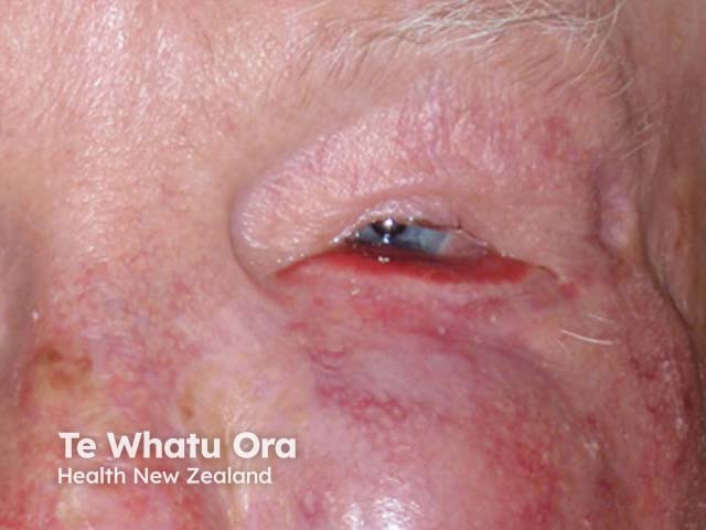 Eyelid melanoma