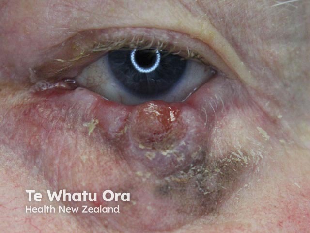 Eyelid melanoma